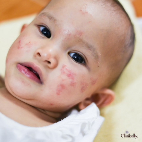 Causes of baby acne