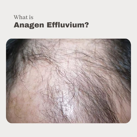 What is Anagen Effluvium?