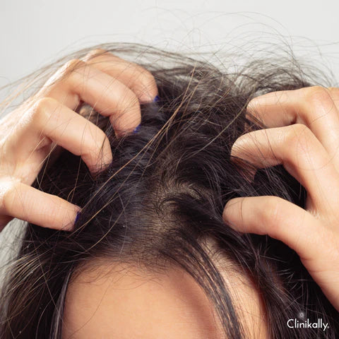 What is the difference between itchy scalp and dandruff?