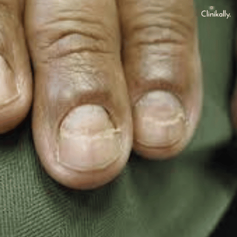 What Causes Fingernails to Split Down the Middle? | livestrong