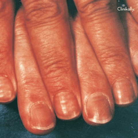 White Spots on Nails: Causes and Treatment