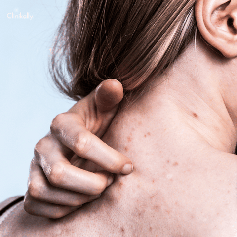 treatment of urticaria