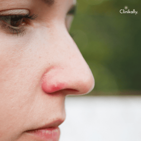 How do you treat a pimple in your nose?