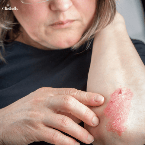 psoriasis treatment