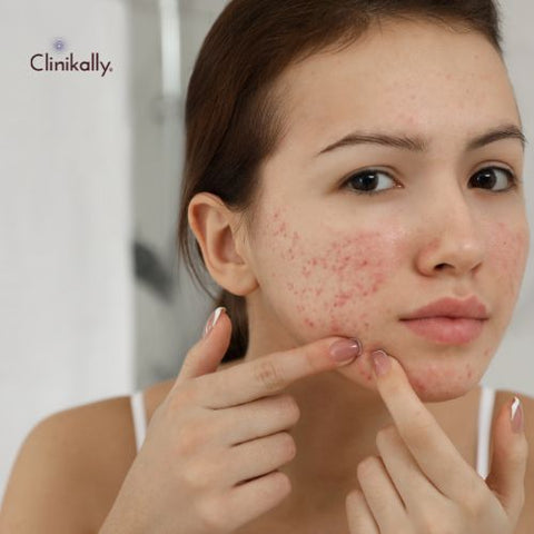 Identifying and Treating Different Types of Acne