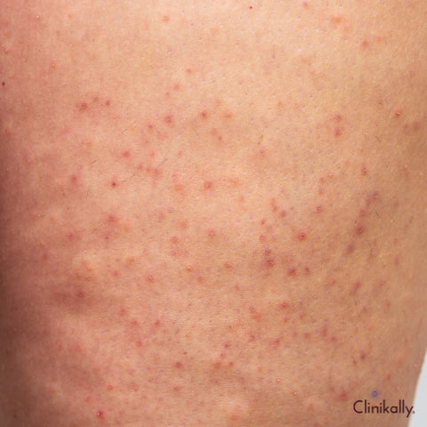 What is Strawberry Skin and How to Treat It?