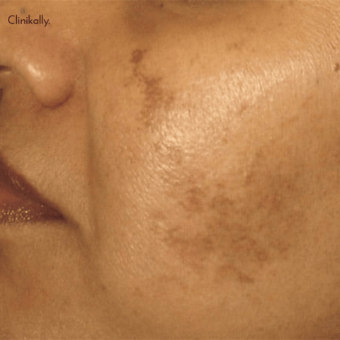 Age Spots (Liver Spots) Treatment Beverly Hills