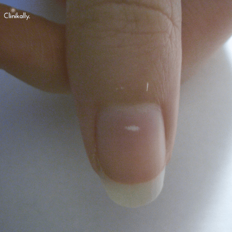 Nail abnormalities: Causes, symptoms, and pictures