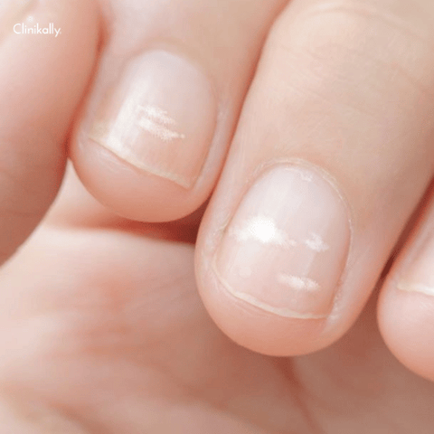 3 Ways to Get Rid of White Spots on Your Nails - wikiHow