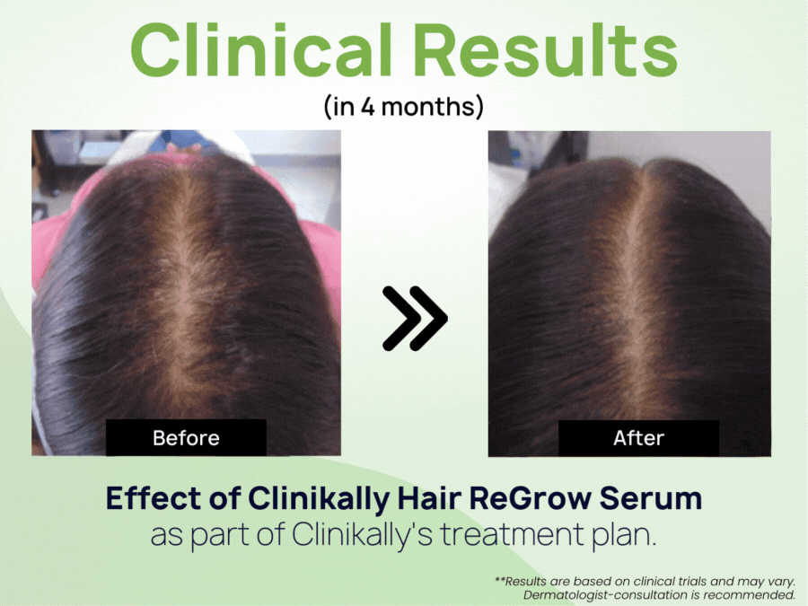 How to Prevent Hair Fall and Naturally Regrow Hair  Be Beautiful India