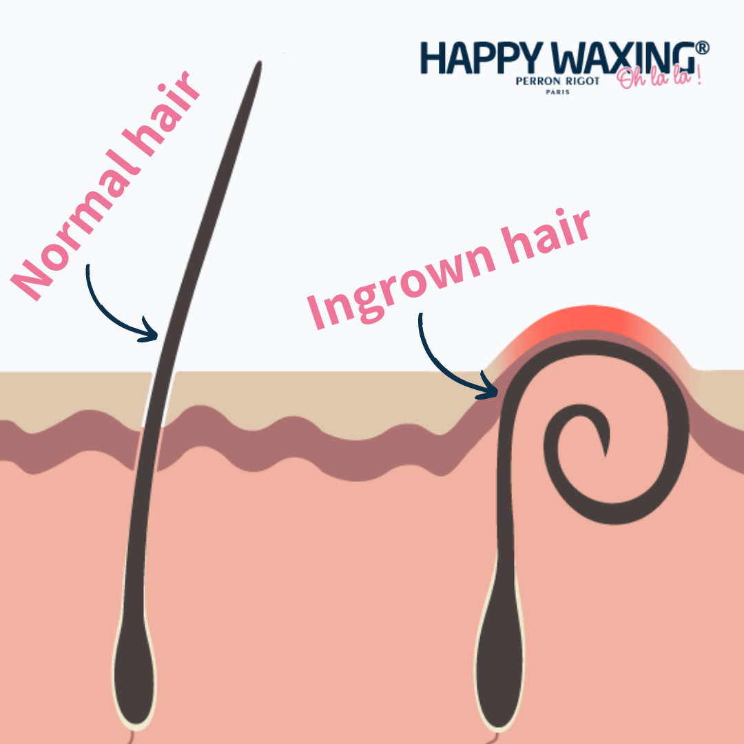 what is ingrown hair