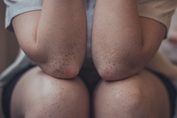 Elbows and knees. Photo by Lucaxx Freire on Unsplash