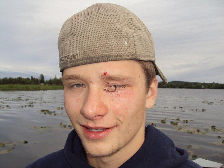 Fishhook Injuries - Keeping Your Eyes Safe! – The Alaska Life
