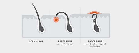 Illustrative diagram of how razor bumps occur