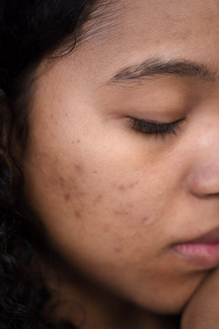 Close up shot of a woman with acne
