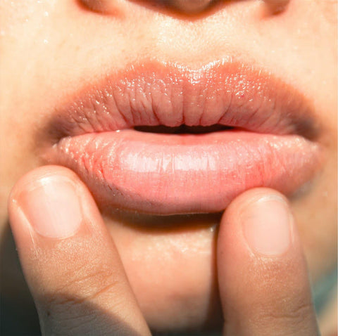Dry lips - Summer Lip-care