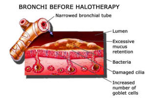 Bronchi Before Halotherapy