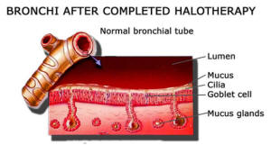 Bronchi After Halotherapy