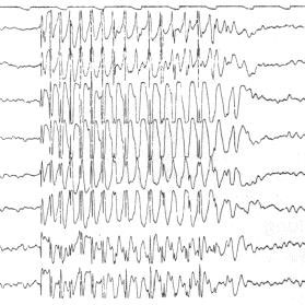 Electroencephalogram showing the electrical activity in the brain
