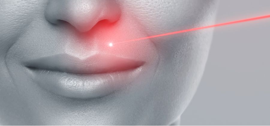 brulure epilation laser
