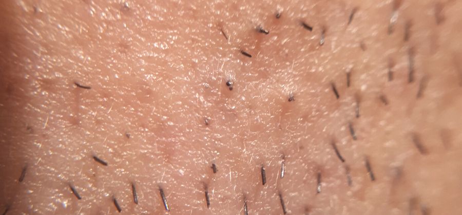 Comment se débarrasser des poils incarnés sur l'anus ? – Mamie Réglisse