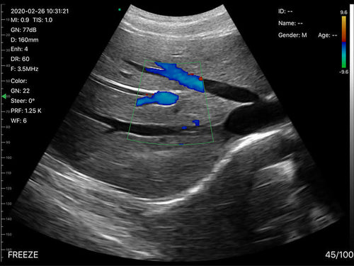Eagleview ultrasound crystal-clear images liver in color doppler mode