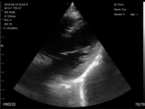 Eagleview ultrasound crystal-clear images cardiac