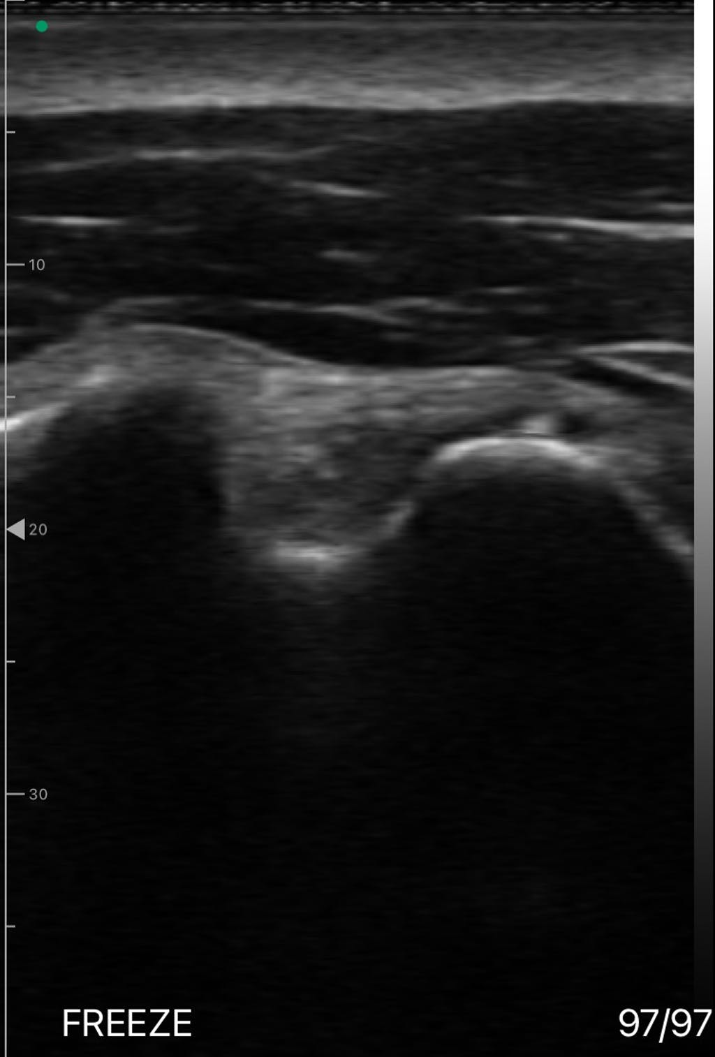 Utilize Eagleview ultrasound to visualize musculoskeletal pathological conditions
