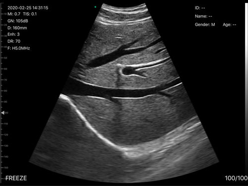 Eagleview ultrasound crystal-clear images liver