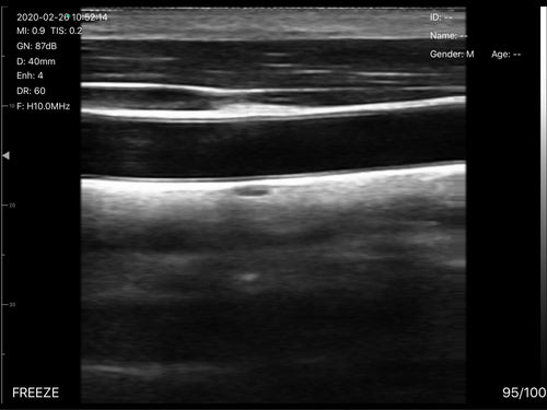 Eagleview ultrasound crystal-clear images vascular