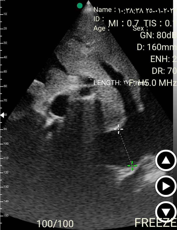 Ultrasonido EagleView en casos cardíacos de UCI