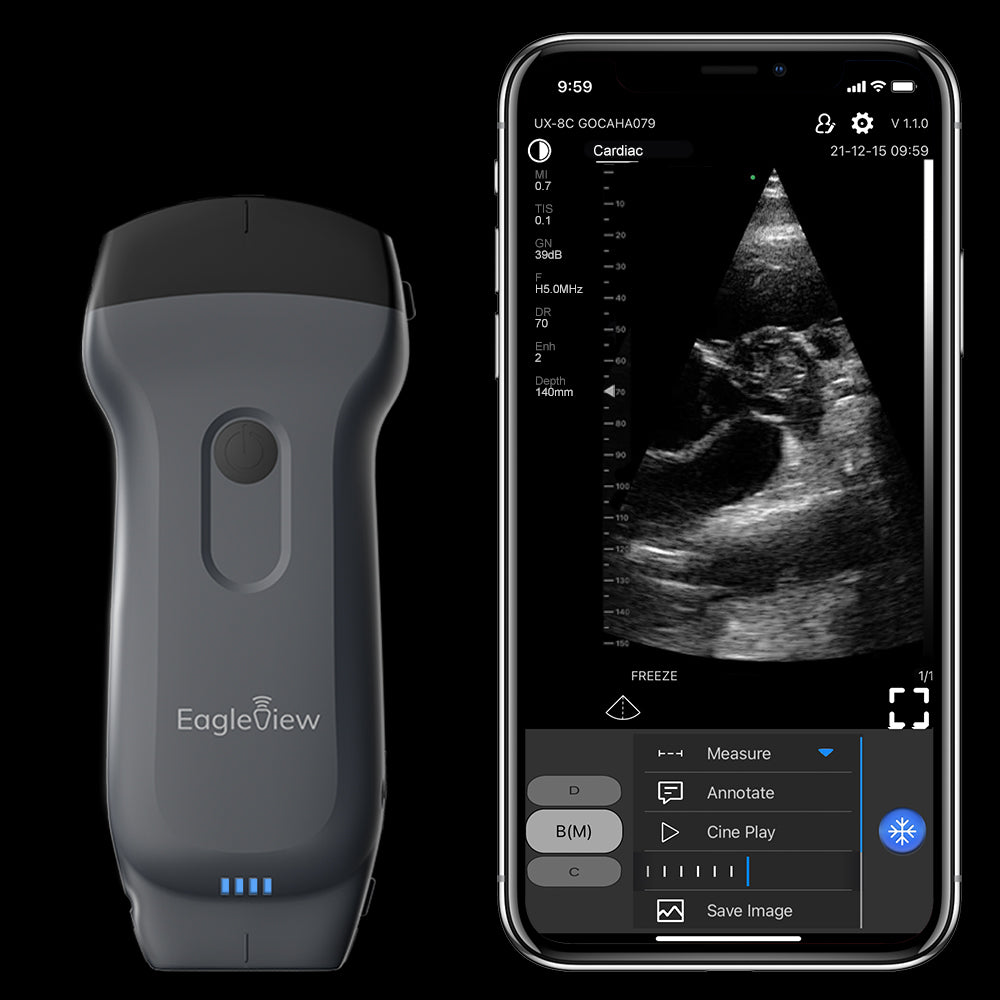 Eagleview™ Pocket Portable Doppler Ultrasound: wireless curvilinear  ultrasound probe for iPad, iPhone and Andriod Phone. – EagleView