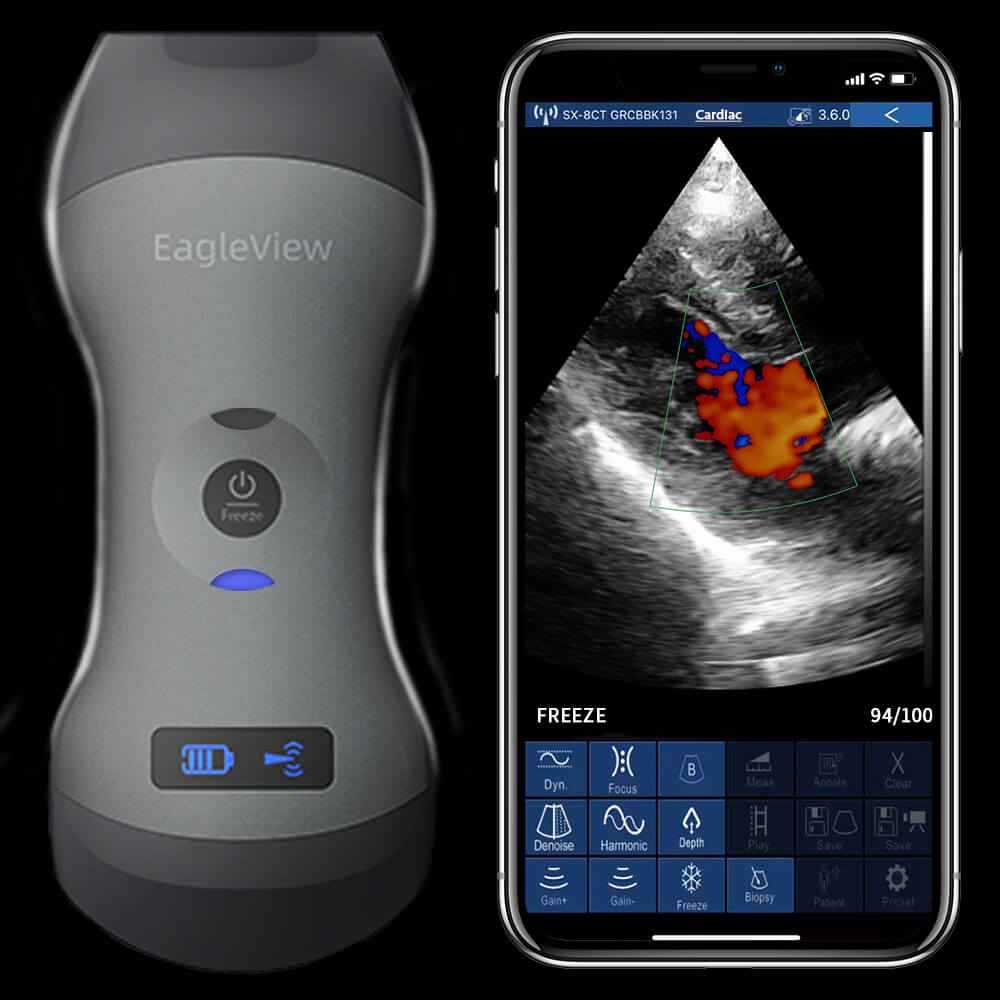 krak fremsætte Meget EagleView Dual-Head (Convex & Linear) Wireless Portable Doppler Ultrasound,  Suitable for Tablet, iPhone and Andriod Phone.