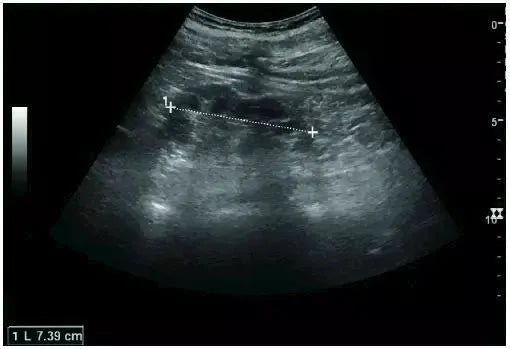 damaged kidney ultrasound