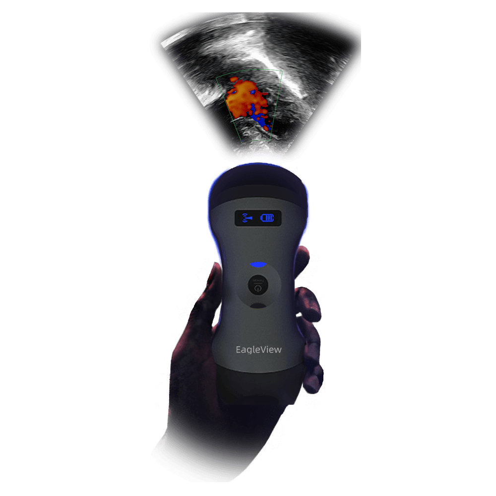 EagleView is a point-of-care ultrasound solution.