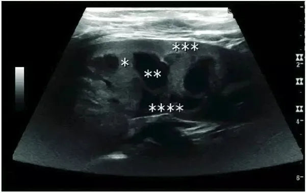 kidney ultrasound images normal