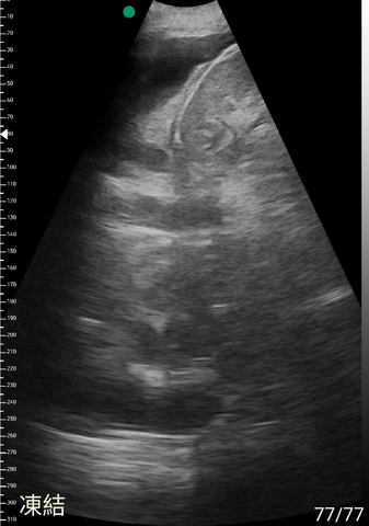 The Application of Mini Ultrasound in Lung Scanning