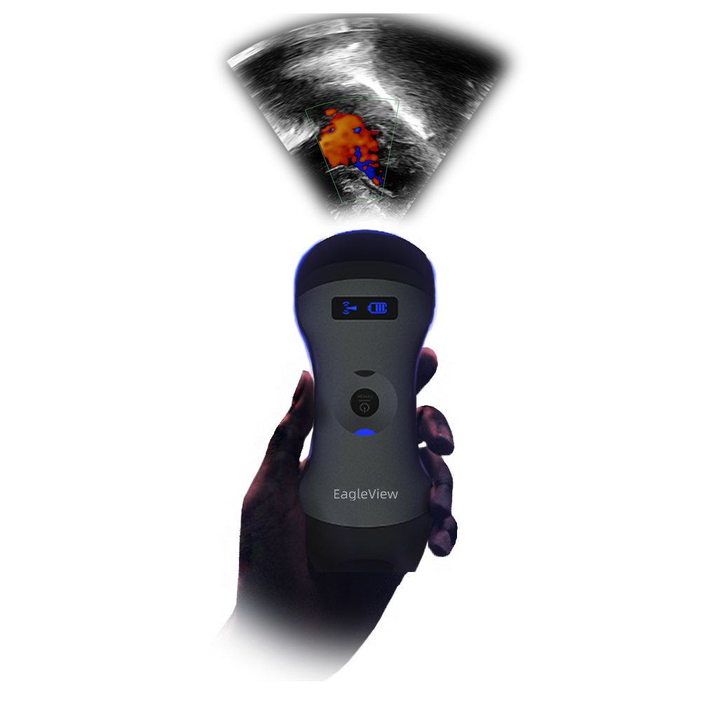 EagleView Portable Wireless Ultrasound Scanner with Linear, Convex and  Phased Array Probe. Compatible with iOS and Android.