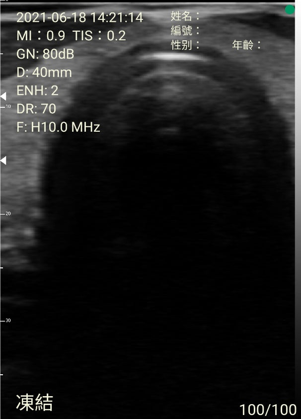 porket ultrasound