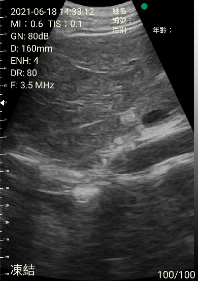 mini ultrasound