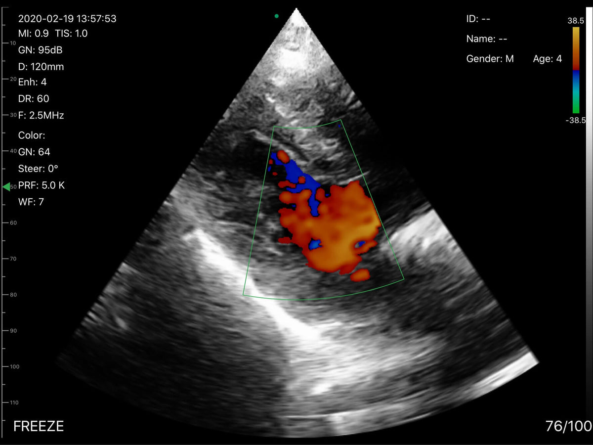 EagleView ultrasound cardiac scanning images with colour doppler