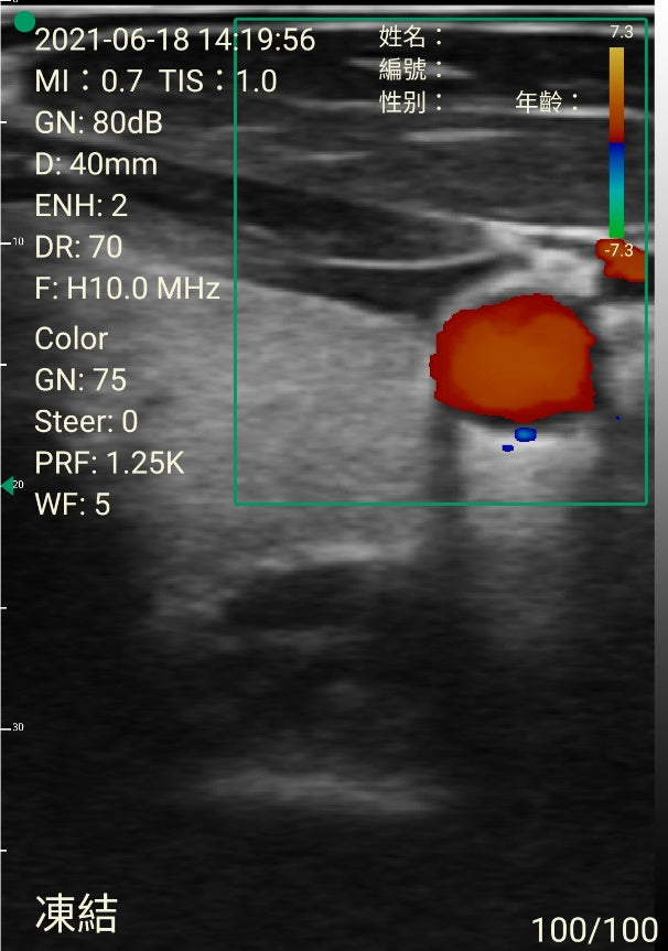 bladder probe