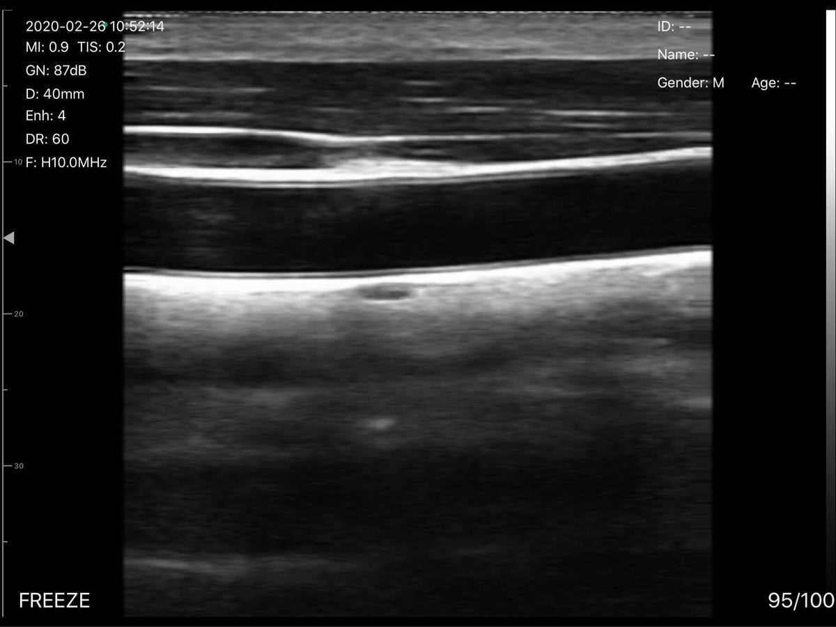 EagleView ultrasound blood vessel scanning image