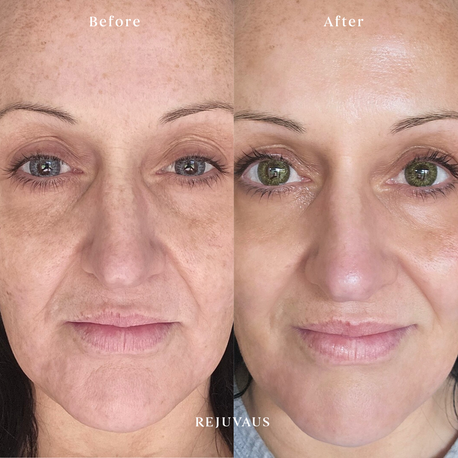 Rejuvaus Vitamin A Before After