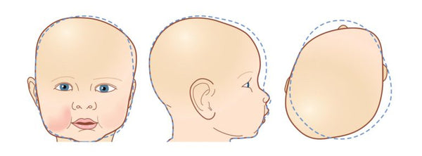 como evitar la plagiocefalia en bebés