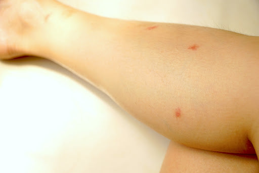 Close up of flea bites on human’s legs