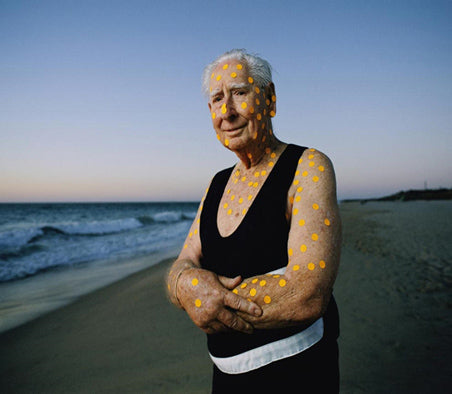 Australian lifeguard skin cancer