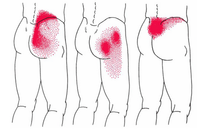 Poor Posture Referred Pain Pattern