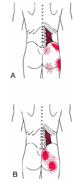 ql muscle release pain patterns