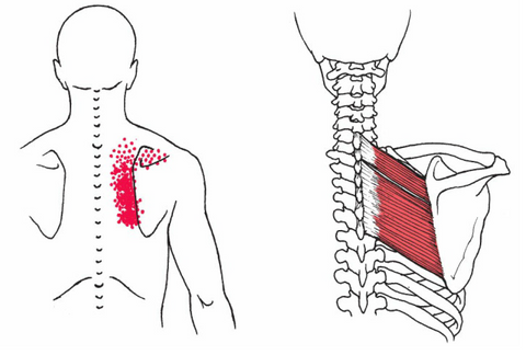 Knot behind shoulder blade - rhomboid pain pattern